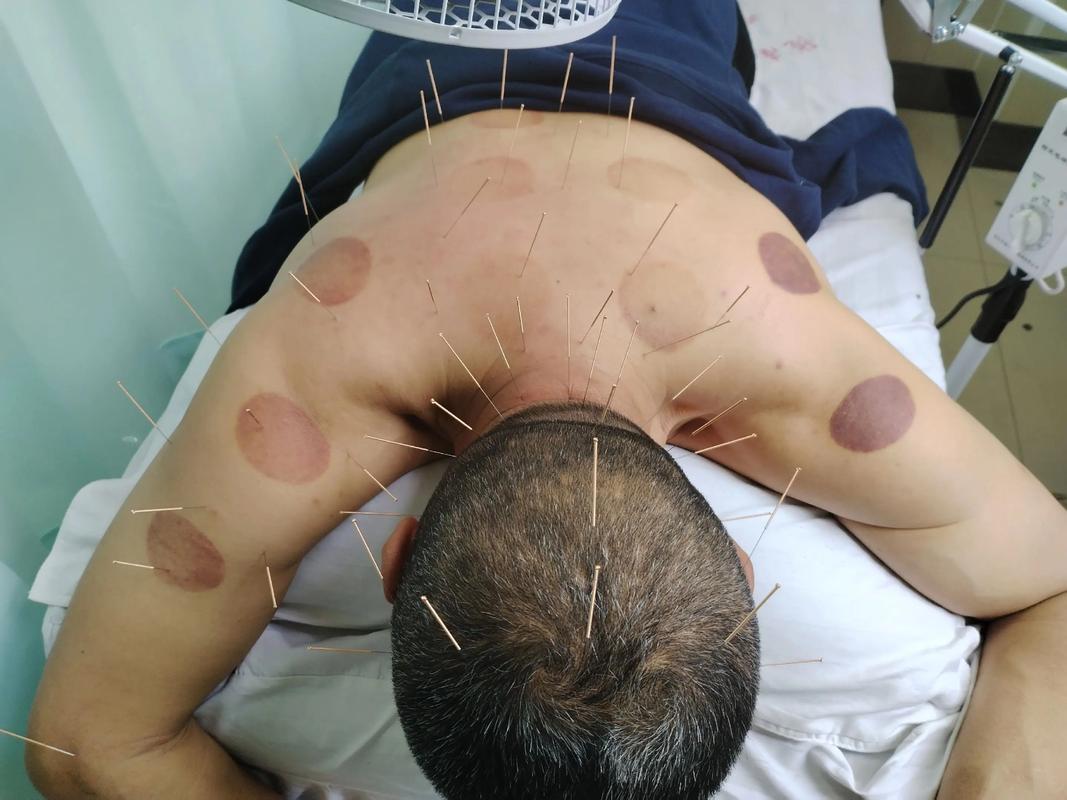 西医没有正骨 针灸