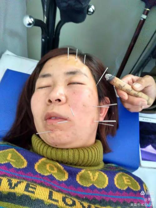 面部针灸 治疗什么