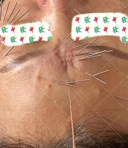 面部针灸 治疗什么