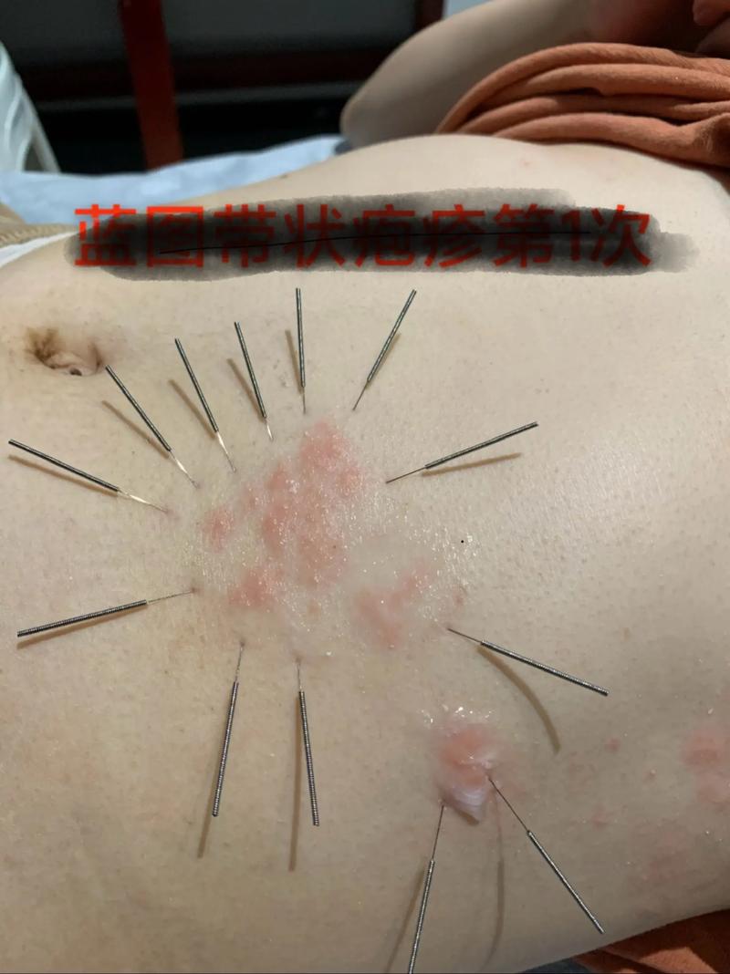 长春 针灸治疗皮炎