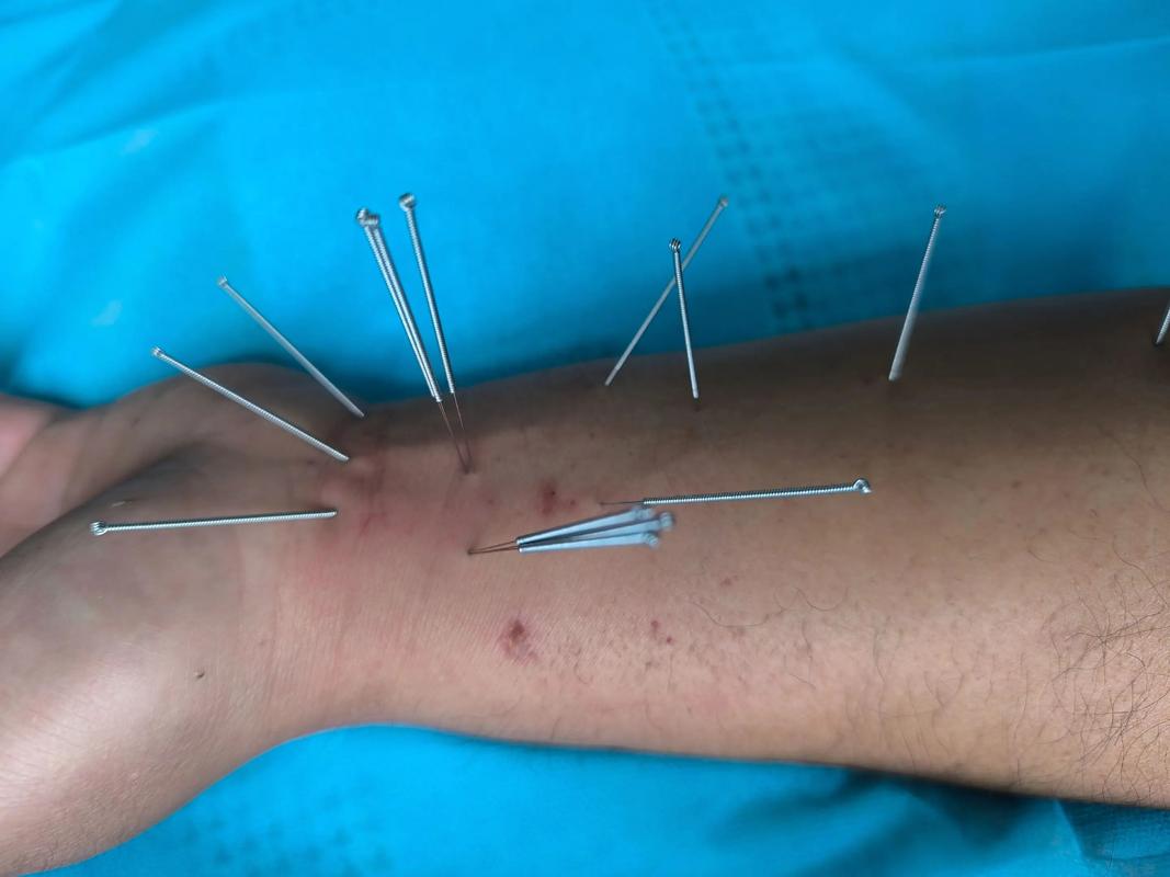 长春 针灸治疗皮炎