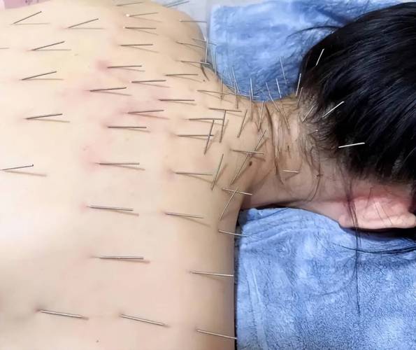 长春 针灸治疗皮炎