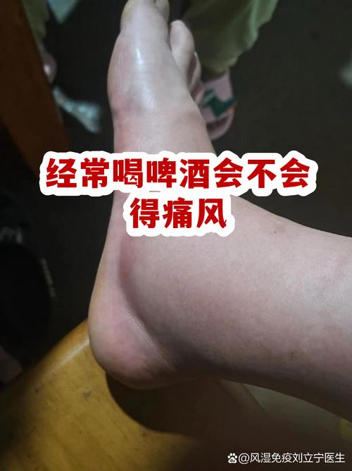 痛风为什么不能喝啤酒