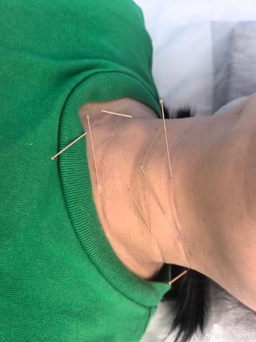 颈部血管斑块 针灸