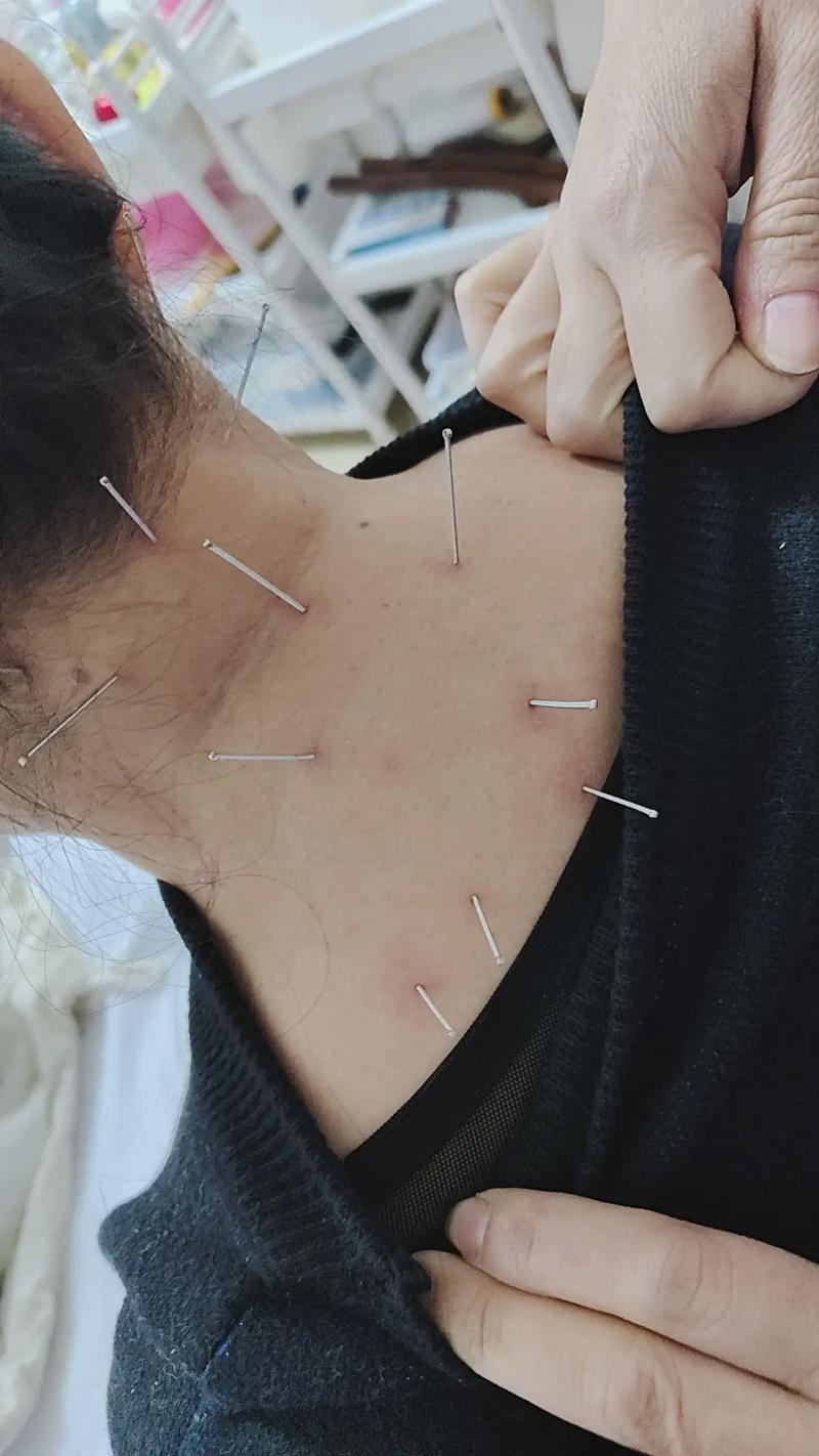 颈部血管斑块 针灸