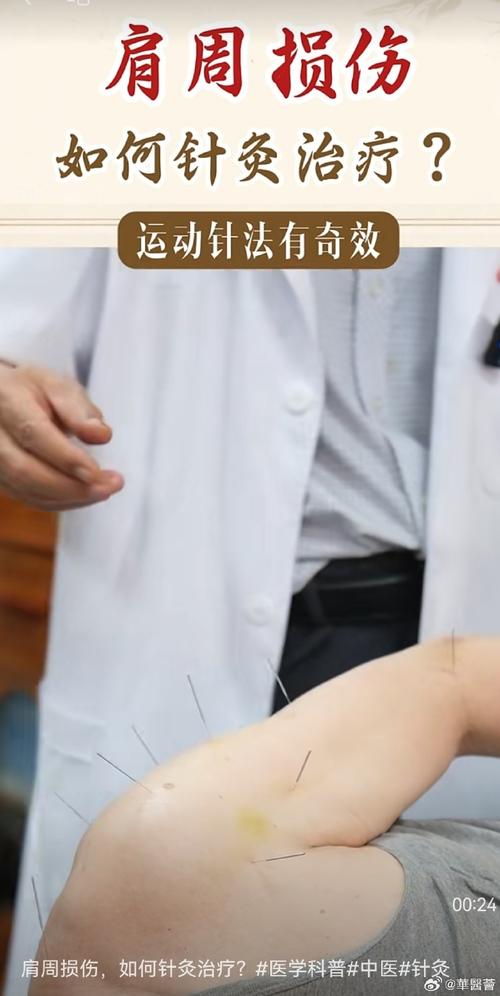 肩周炎针灸诊疗技术