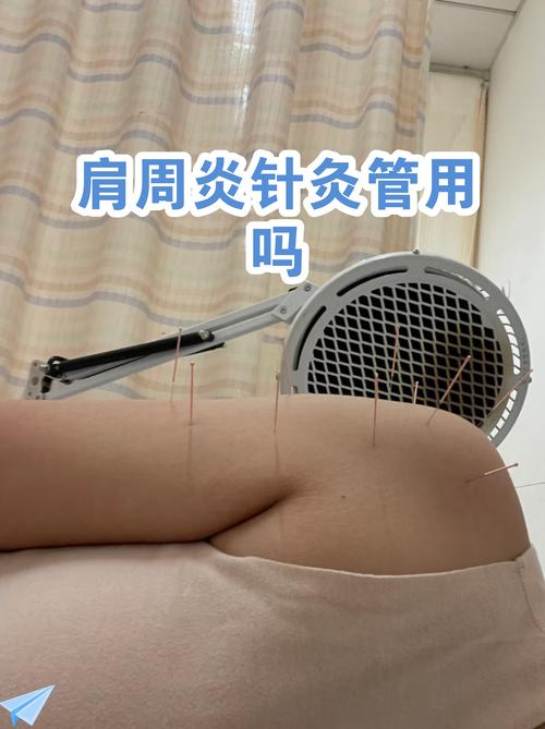 肩周炎针灸诊疗技术