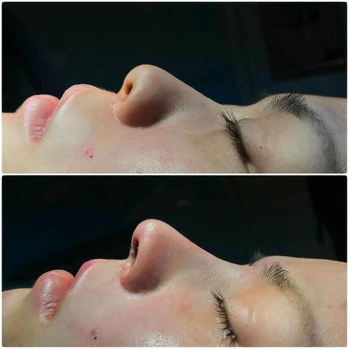 做鼻子那种最安全永久