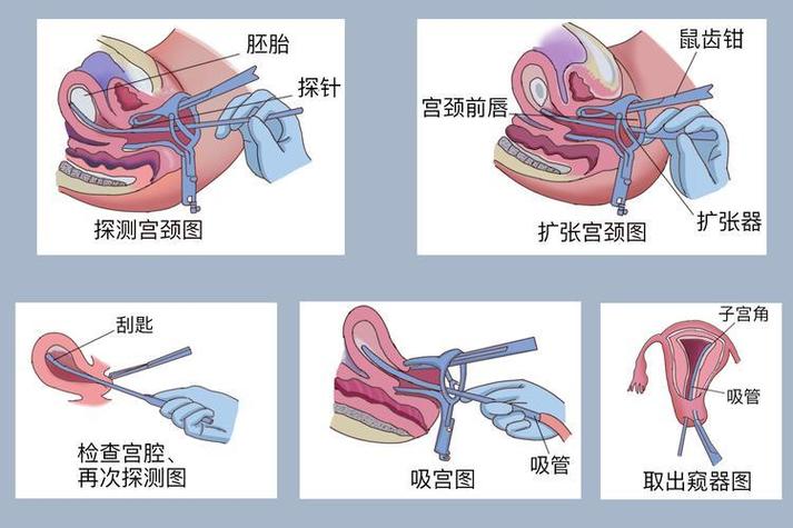 打胎做什么手术最安全