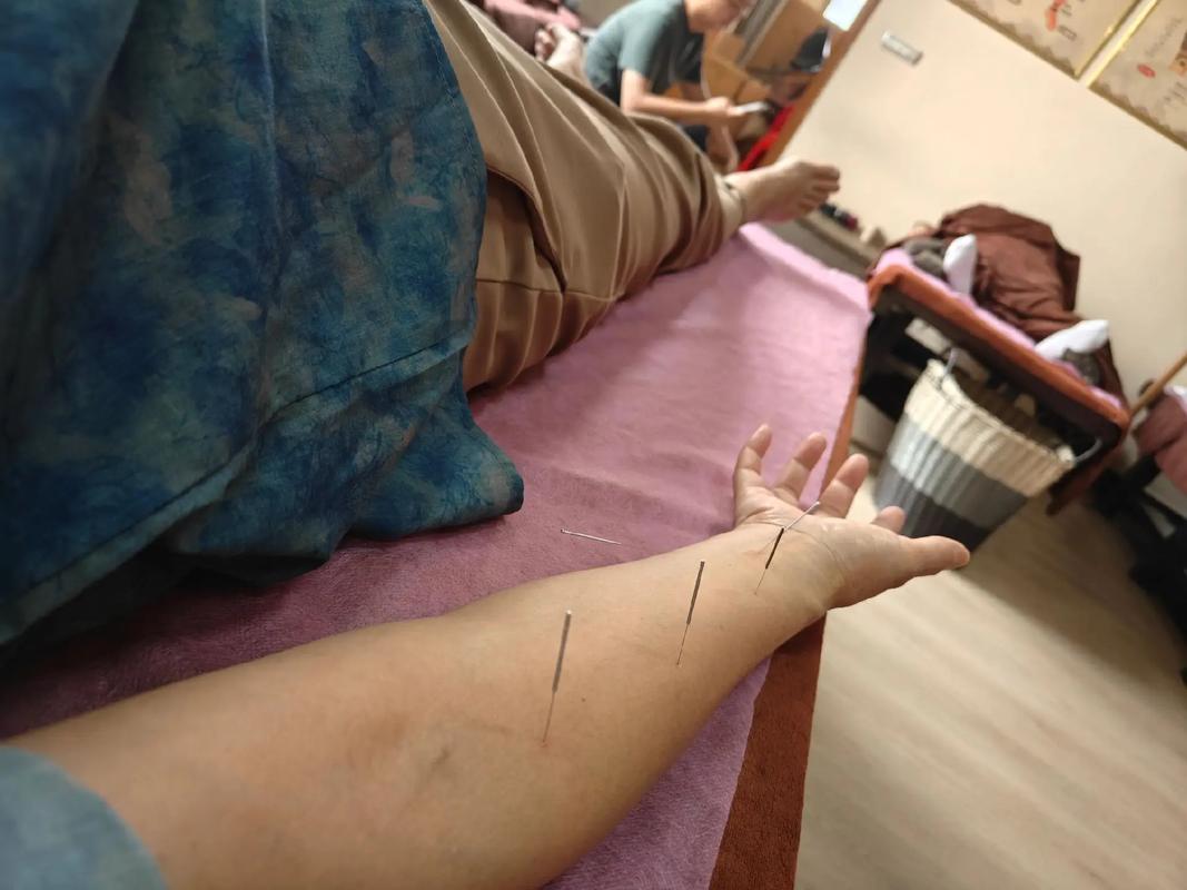 针灸晚上可以针灸吗