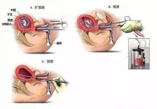目前最安全的人流手术