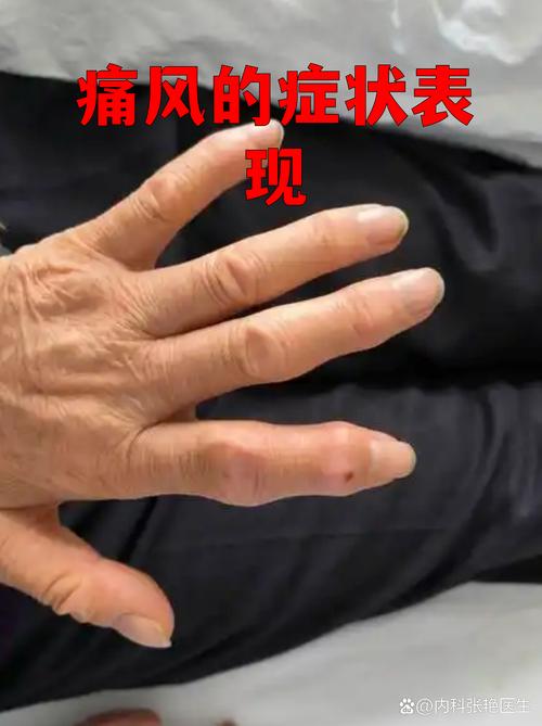 什么是痛风有什么症状