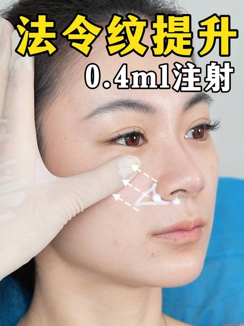 玻尿酸填充鼻子安全吗