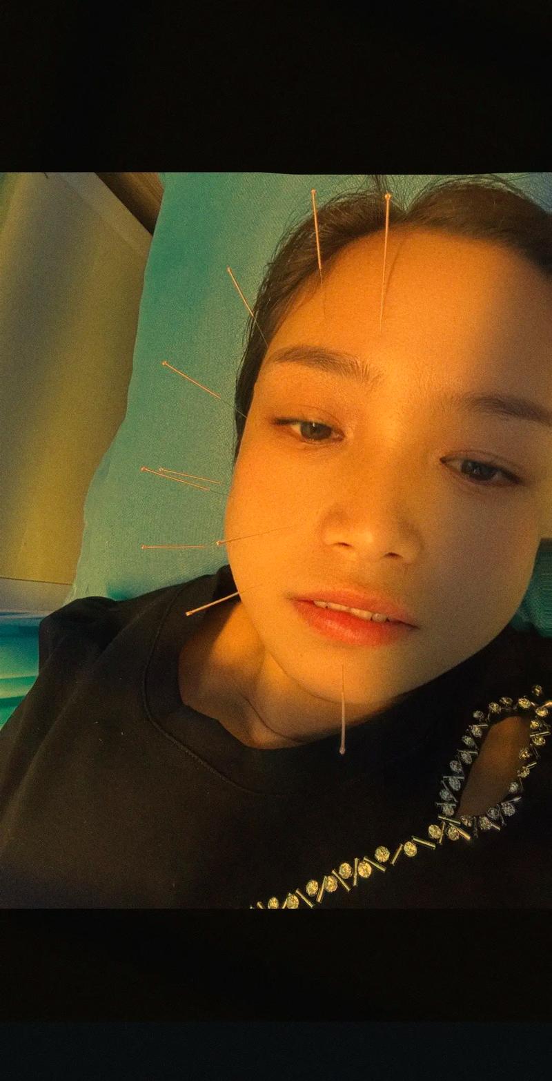 面瘫第一周能针灸吗