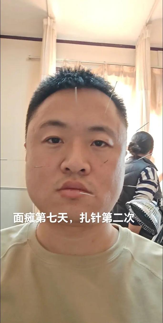 面瘫第一周能针灸吗
