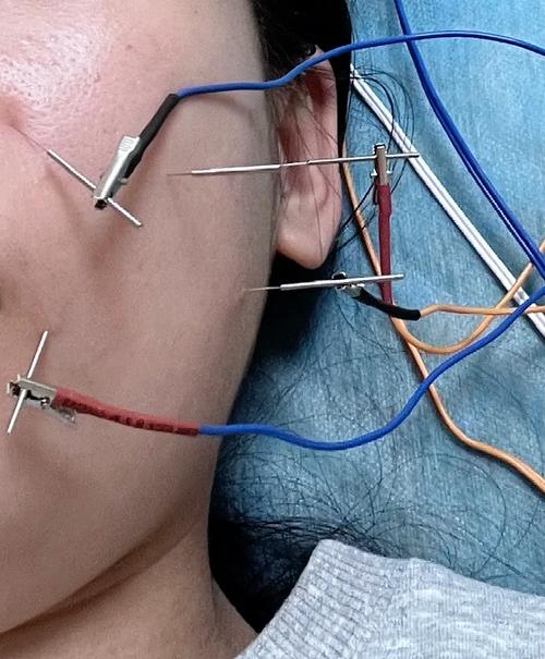 面瘫第一周能针灸吗