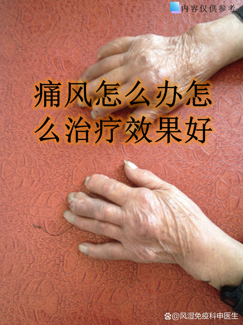 痛风不能吃维生素c吗