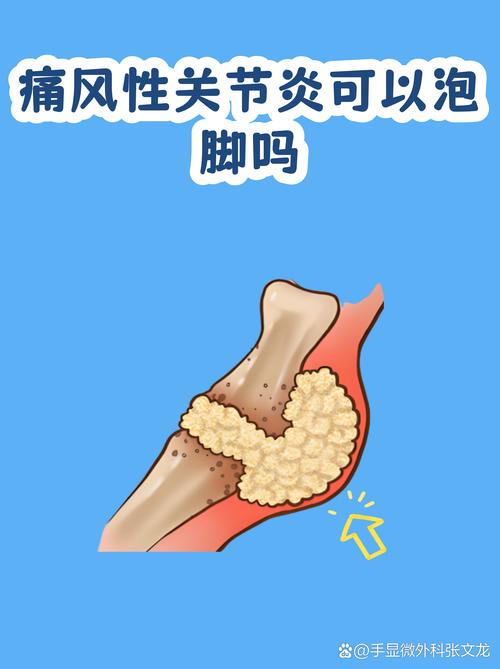 痛风发作期能泡温泉吗