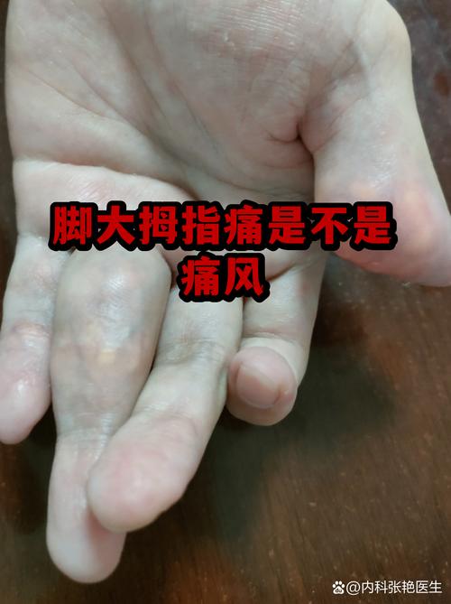 右脚大拇指痛风怎么办