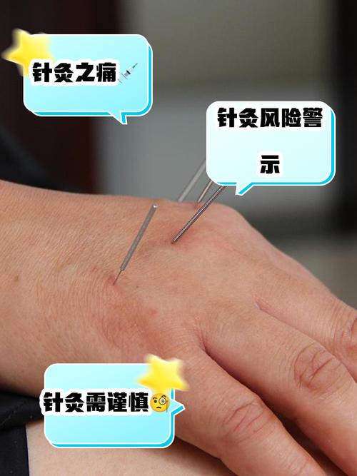 淋巴结核可以针灸吗