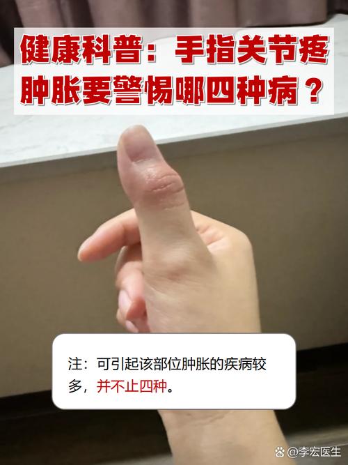 痛风手肿怎么消肿止痛