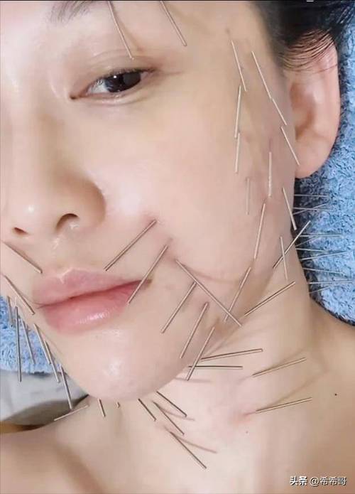 面部三叉神经痛针灸