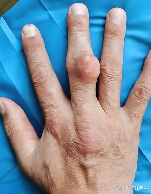 你会嫁给痛风的男人么