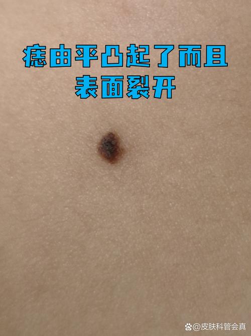 痣突出皮肤表面安全吗