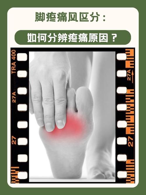 痛风是骨头痛还是肉痛