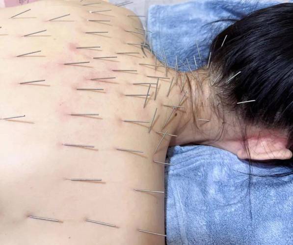 针灸后第二天特别痛
