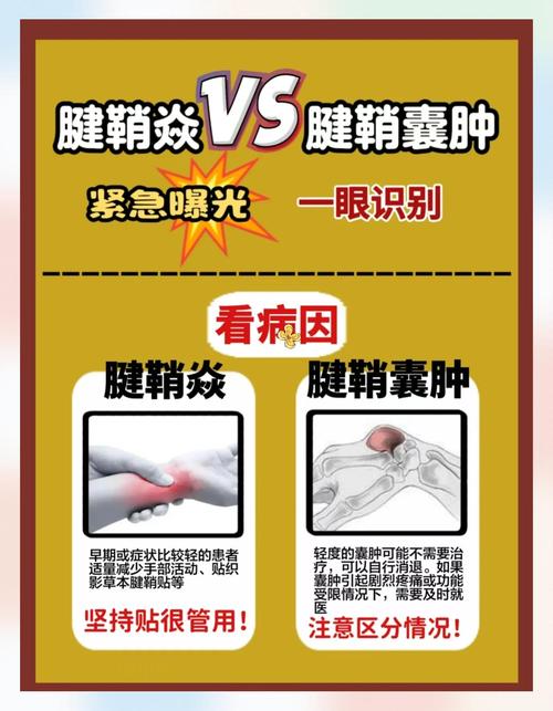 手腕痛风和腱鞘炎区别