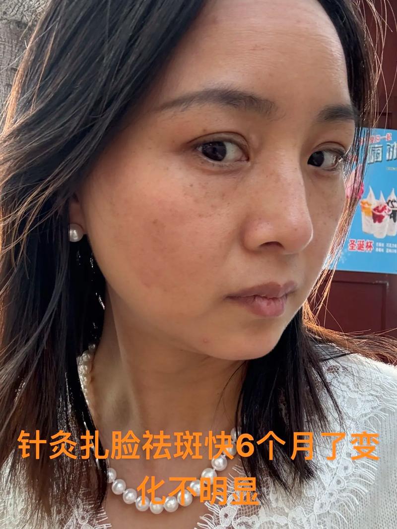 针灸去斑要多长时间