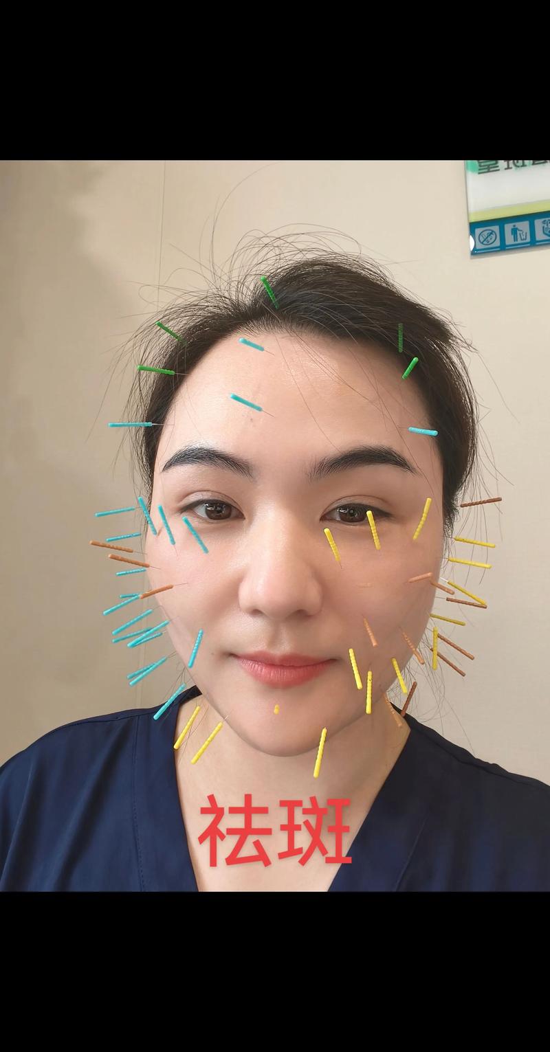 针灸去斑要多长时间