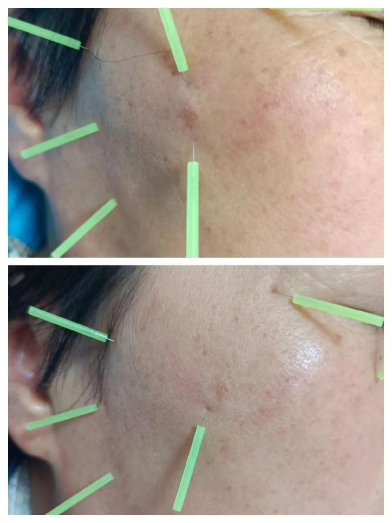 针灸去斑要多长时间