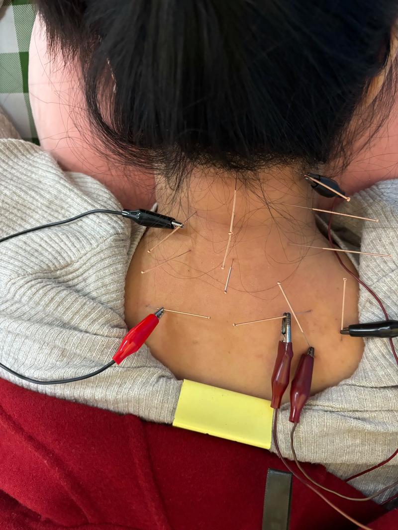 大连针灸一次多少钱