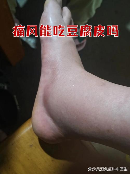 痛风的人可以吃豆皮吗