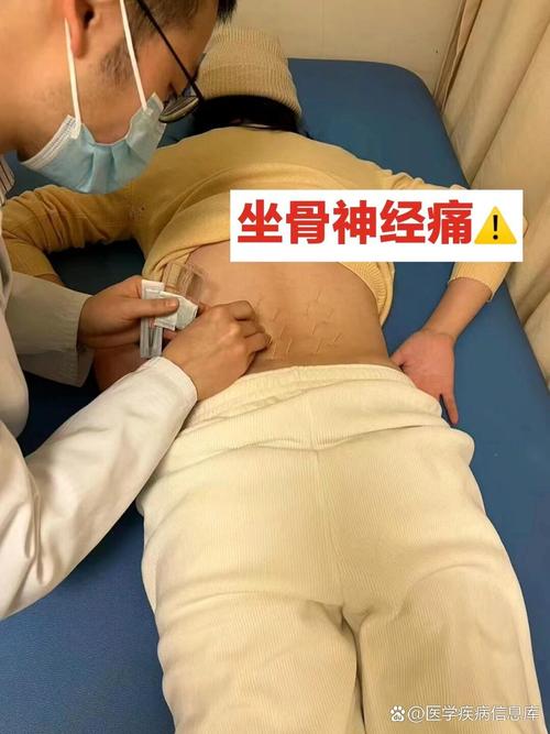平衡针灸坐骨神经痛