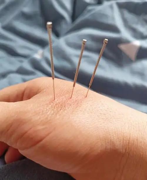 平衡针灸坐骨神经痛