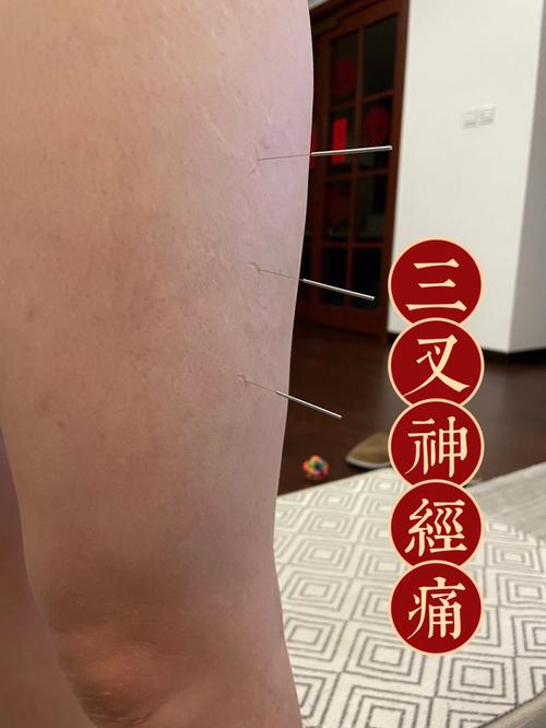 三叉神经针灸会好吗