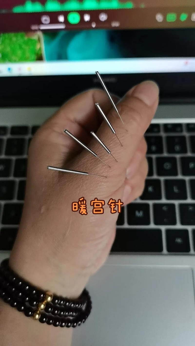 平衡针灸失三针是啥