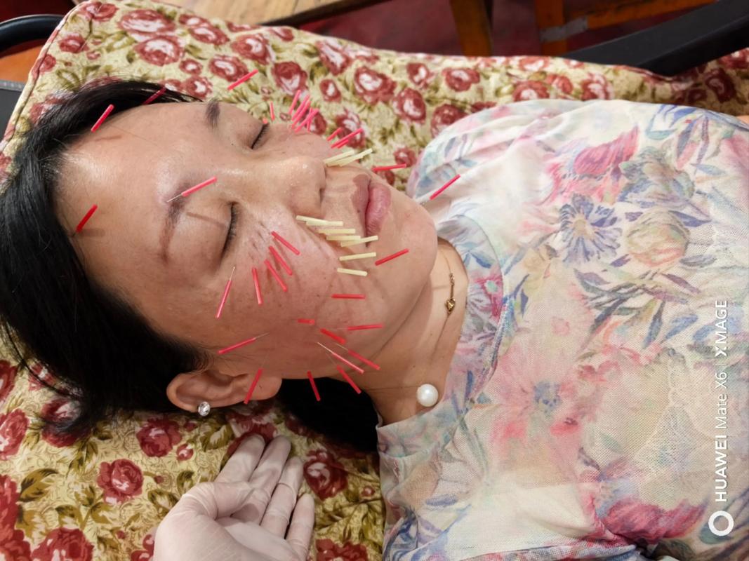 面部针灸多少钱一次