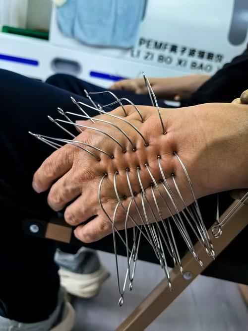 针灸治疗过敏性紫癜