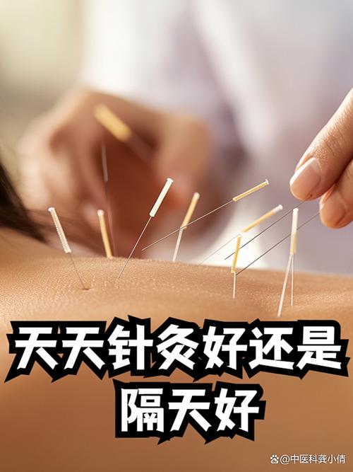 针灸能提高记忆力吗