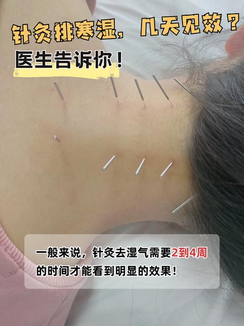 荨麻疹针灸能治好吗