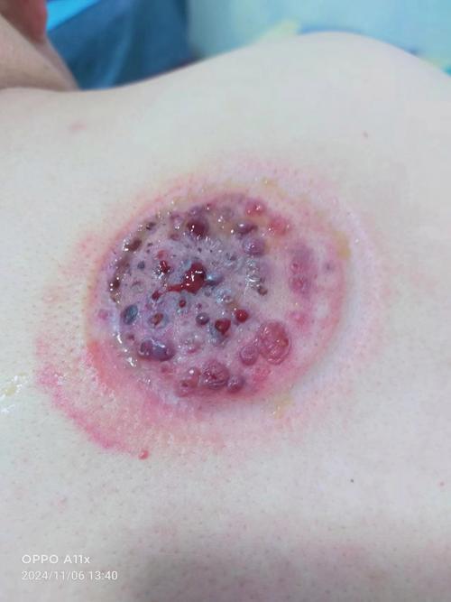 针灸拔罐后能喝酒吗