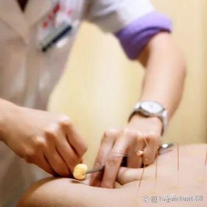 珠海中医院针灸减肥