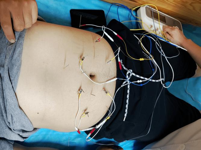 珠海中医院针灸减肥