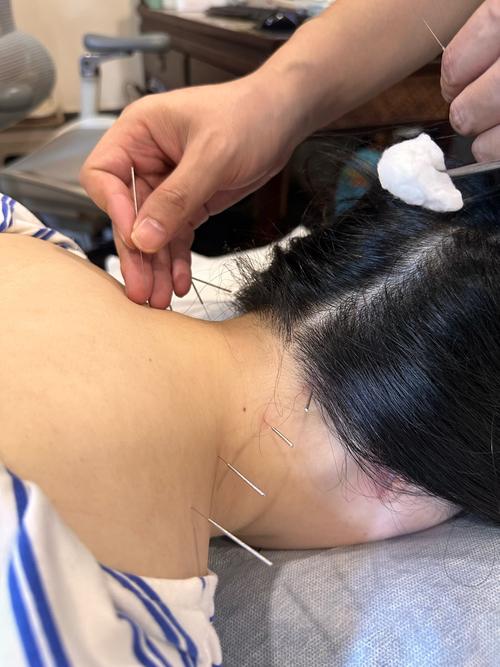 针灸可以去黄褐斑吗