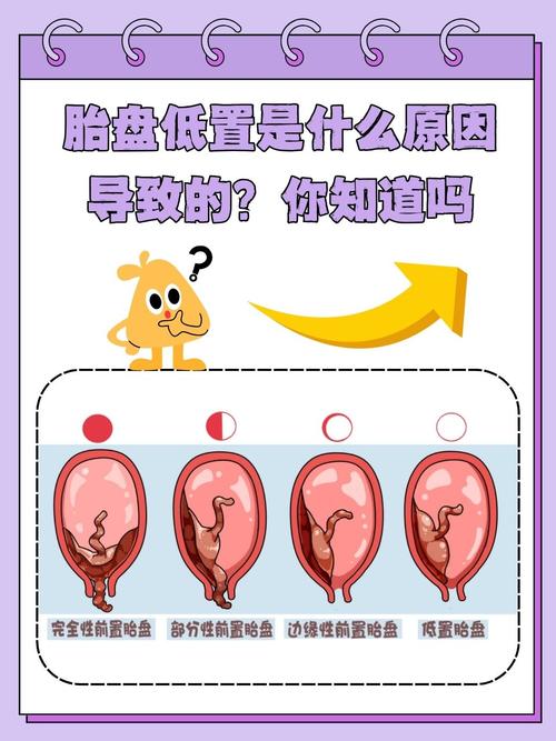 胎盘植入面积多少安全