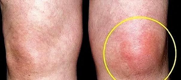 痛风会在膝盖什么位置